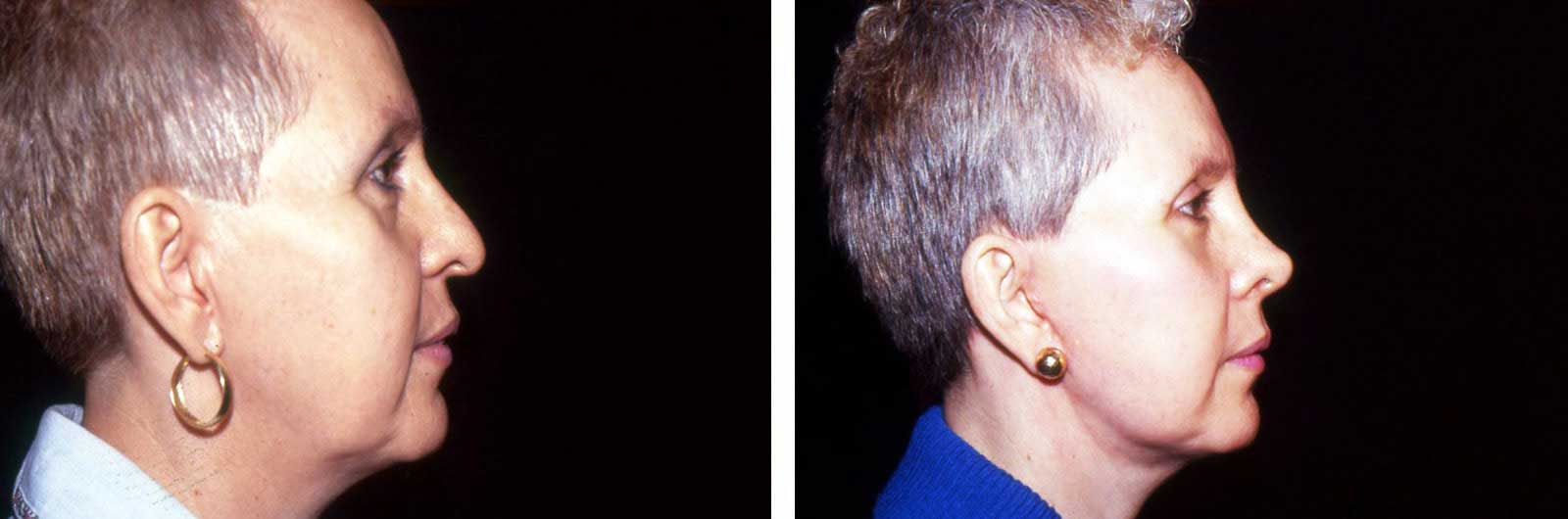 Cirugía de nariz (Rinoplastía) | Dr. Manlio Speziale