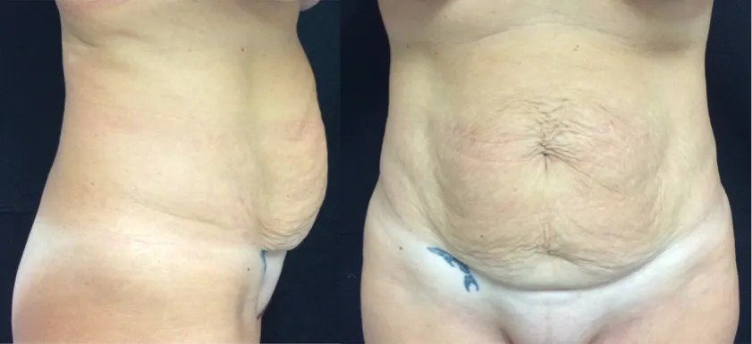 Abdominoplastía