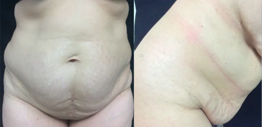 Abdominoplastía