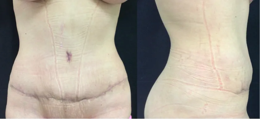 Abdominoplastía