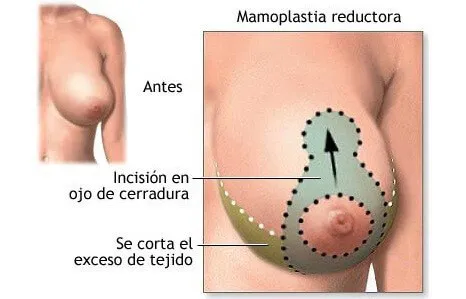 Reducción Mamaría