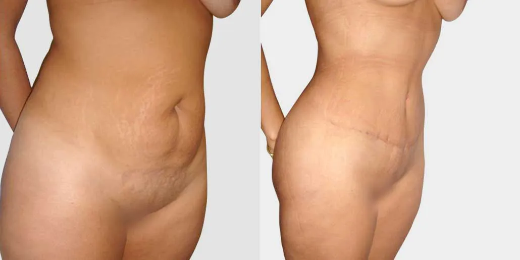 Abdominoplastía por Dr. Manlio Speziale