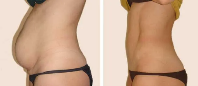 Abdominoplastía por Dr. Manlio Speziale