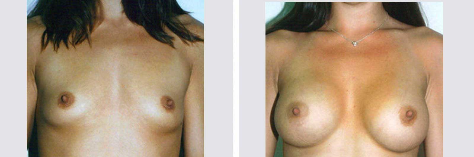 Cirugía de aumento de senos por Dr. Manlio Speziale