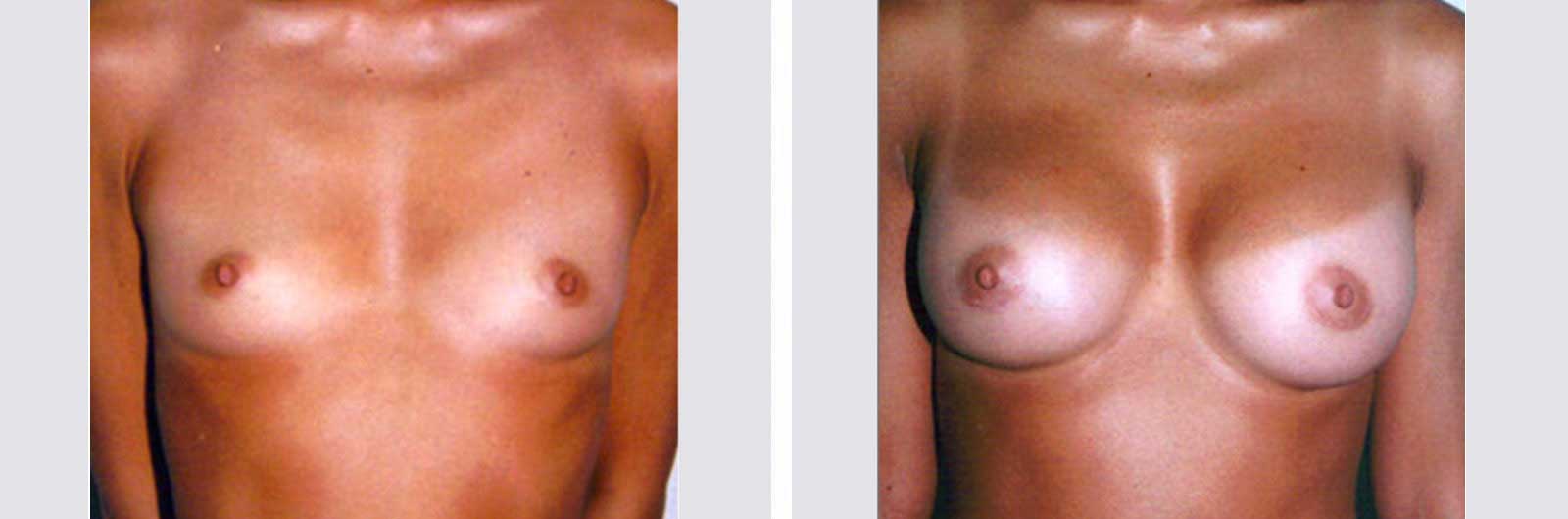 Cirugía de aumento de senos por Dr. Manlio Speziale