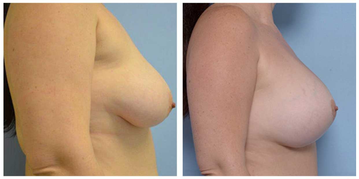 Cirugía de levantamiento de senos por Dr. Manlio Speziale