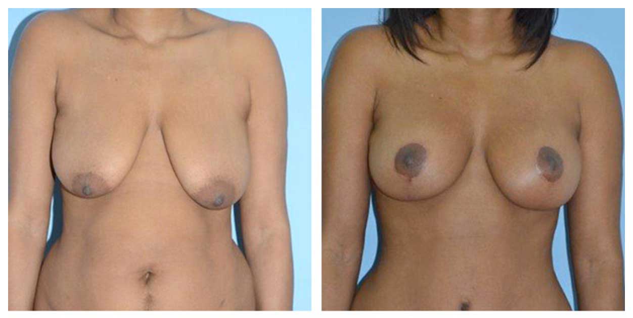 Cirugía de levantamiento de senos por Dr. Manlio Speziale