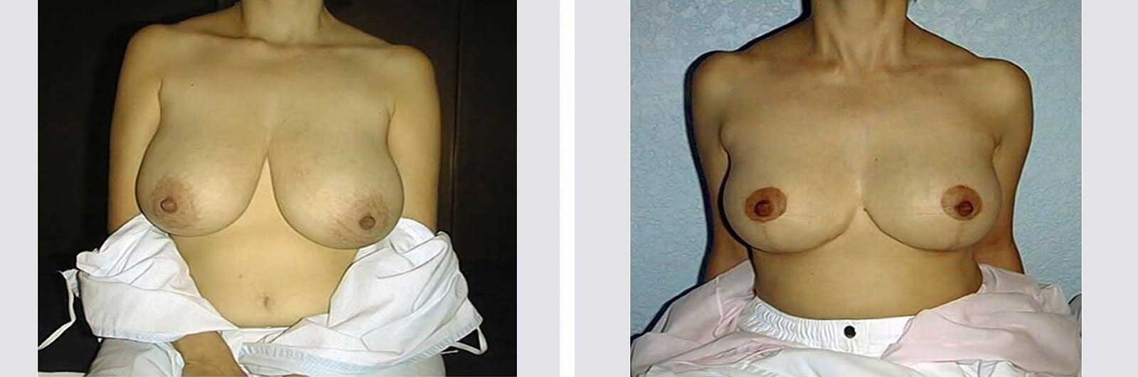 Cirugía de reducción de senos por Dr. Manlio Speziale