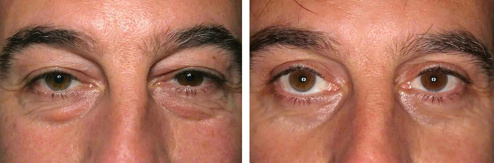 Cirugía de Ojos (Blefaroplastia) | Dr. Manlio Speziale