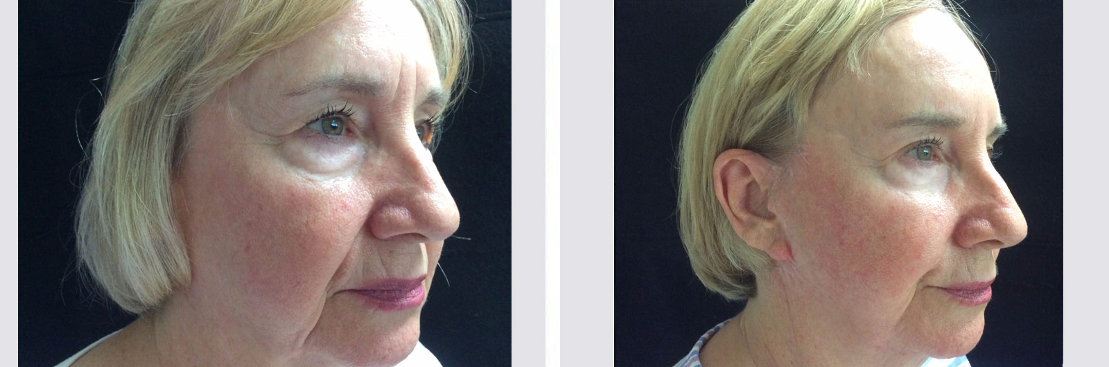Lifting Facial (Ritidectomía) | Dr. Manlio Speziale