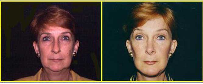 Lifting Facial (Ritidectomía) | Dr. Manlio Speziale